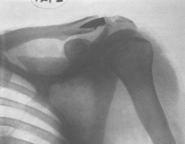 X-ray of shoulder, with bullet