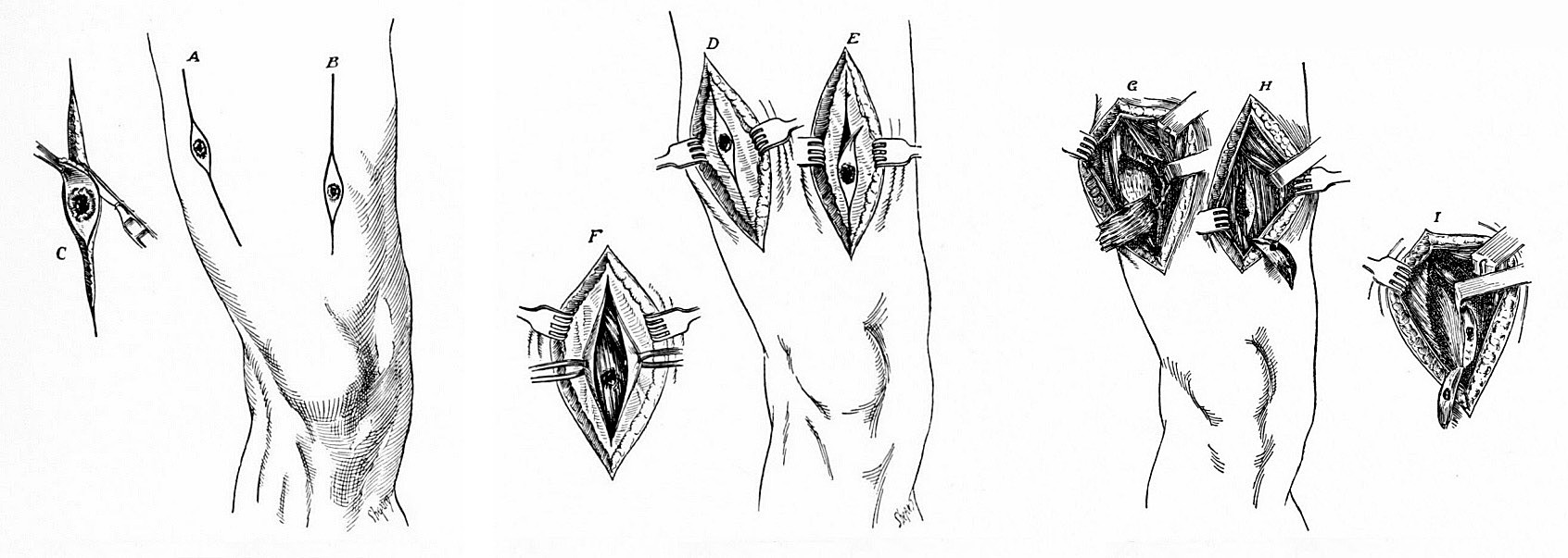 Debridement of a Wound