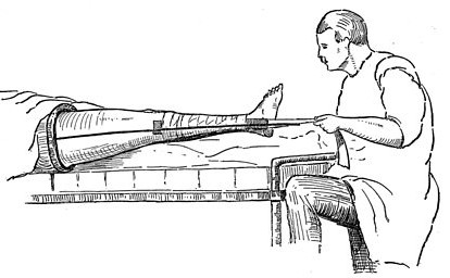 Thomas Splint 2