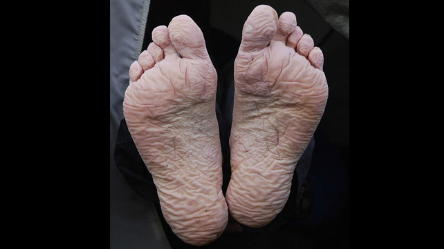 ID Trench Foot